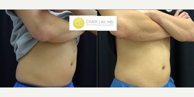 CoolSculpting before and after photo