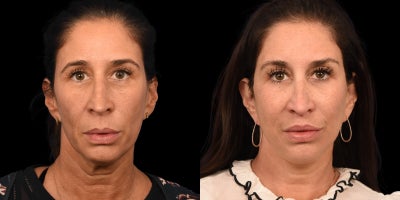 before and after image