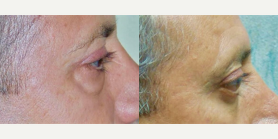 Double Eyelid Surgery before and after photo