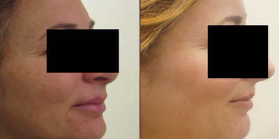Fraxel Laser before and after photo