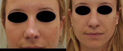 Nonsurgical Nose Job before and after photo