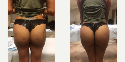 Sculptra before and after photo