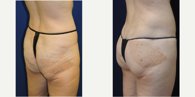 Brazilian Butt Lift before and after photo