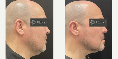 Chin Filler before and after photo