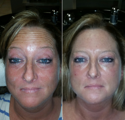 Dermal Fillers before and after photo