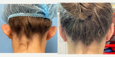 Ear Surgery before and after photo
