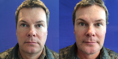 Liquid Facelift before and after photo