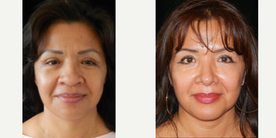 Rhinoplasty before and after photo
