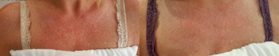 IPL before and after photo