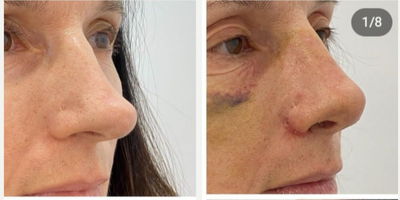 Rhinoplasty before and after photo
