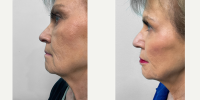 Chin Filler before and after photo