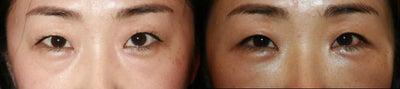 Eyelid Surgery before and after photo