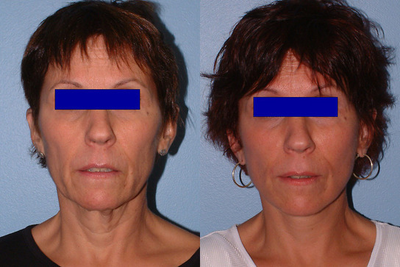 Facelift before and after photo
