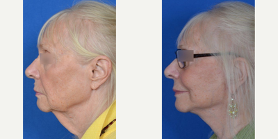 Neck Lift before and after photo