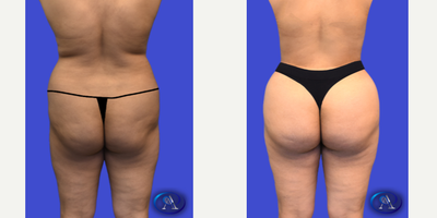 Brazilian Butt Lift before and after photo