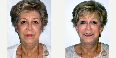 Brow Lift before and after photo