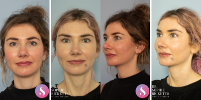 Eyelid Surgery before and after photo