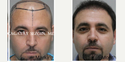 Hair Transplant before and after photo