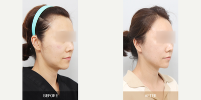 Mini Facelift before and after photo