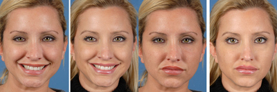 Botox before and after photo