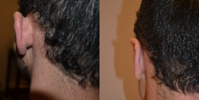 Ear Surgery before and after photo