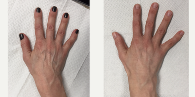 Radiesse before and after photo