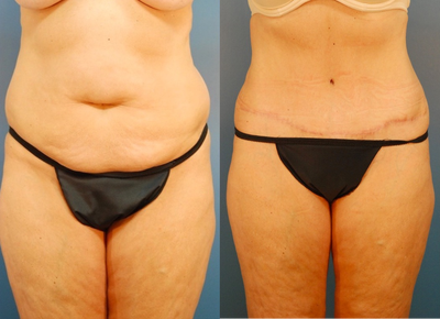 Tummy Tuck before and after photo