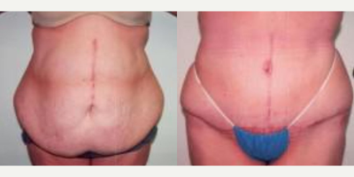 Tummy Tuck before and after photo