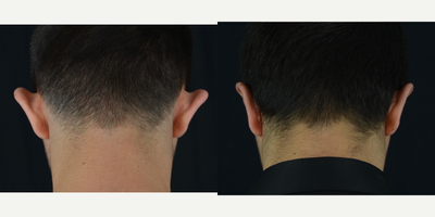 Ear Surgery before and after photo