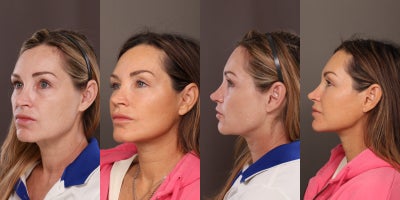 Eyelid Surgery before and after photo