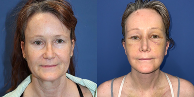 Facelift before and after photo