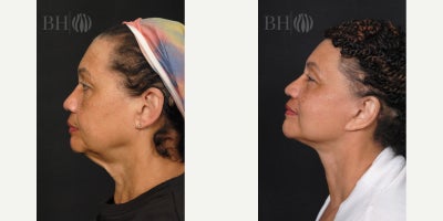 Facelift before and after photo