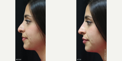 Nonsurgical Nose Job before and after photo