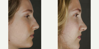 Rhinoplasty before and after photo