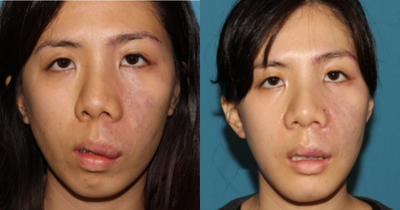 Rhinoplasty before and after photo