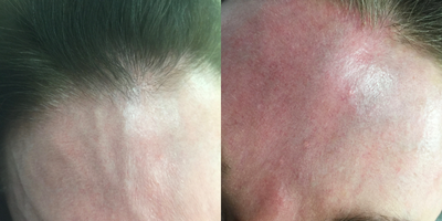 Sclerotherapy before and after photo