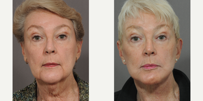 Brow Lift before and after photo