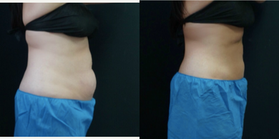 CoolSculpting before and after photo