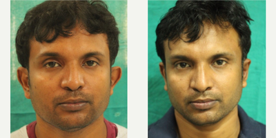 Ear Surgery before and after photo