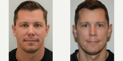 Eyelid Surgery before and after photo
