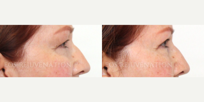 Eyelid Surgery before and after photo