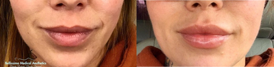 Lip Fillers before and after photo