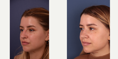 Rhinoplasty before and after photo