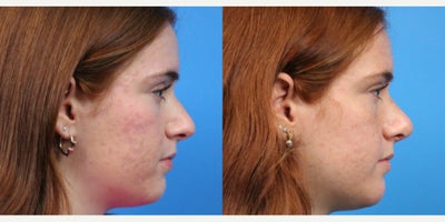 Rhinoplasty before and after photo