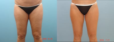 Smart Lipo before and after photo
