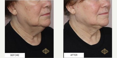 Chin Liposuction before and after photo