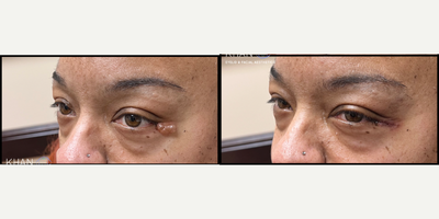 Cyst Removal before and after photo