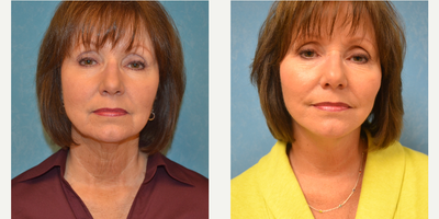 Facelift before and after photo
