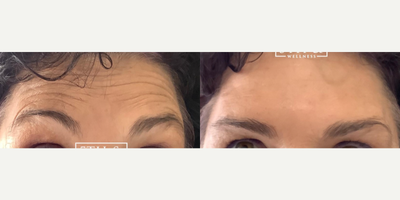 Botox before and after photo