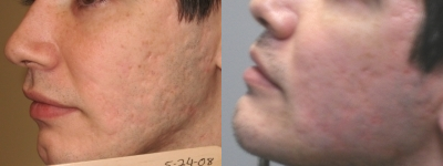 CO2 Laser before and after photo